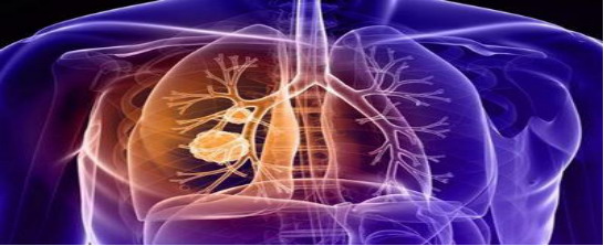 临淄区某医院骨折患者肺栓塞致死案例